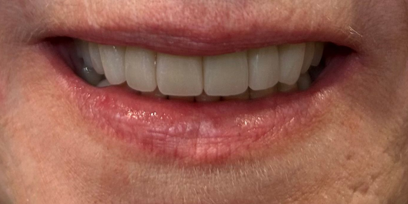 A close up of a woman 's smile with white teeth.