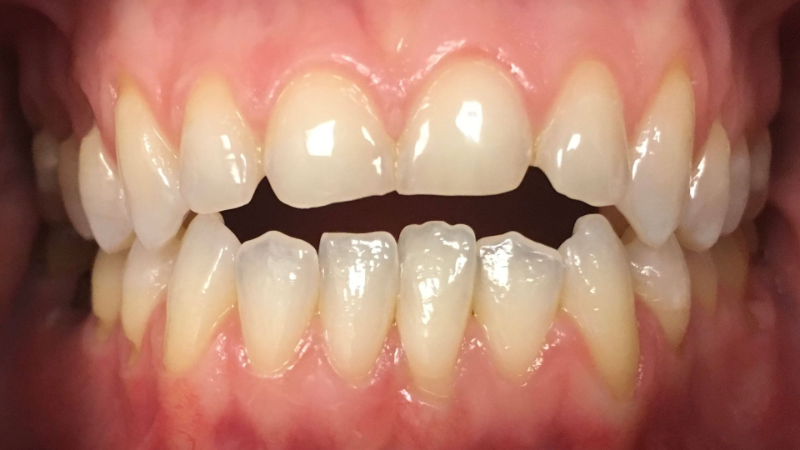 A close up of a person 's teeth with a broken tooth.
