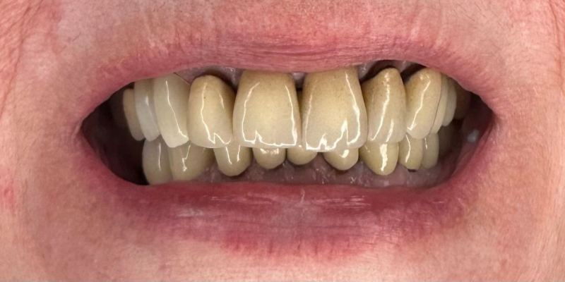 A close up of a person 's teeth with a lot of plaque on them.