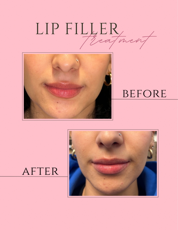 Lip filler before-and-after collage showing close-up lips on a pink background.