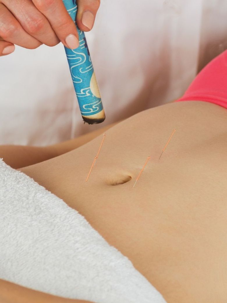 Acupuncture for Fertility Acupuncture for Fertility