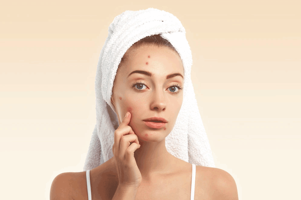 eczema