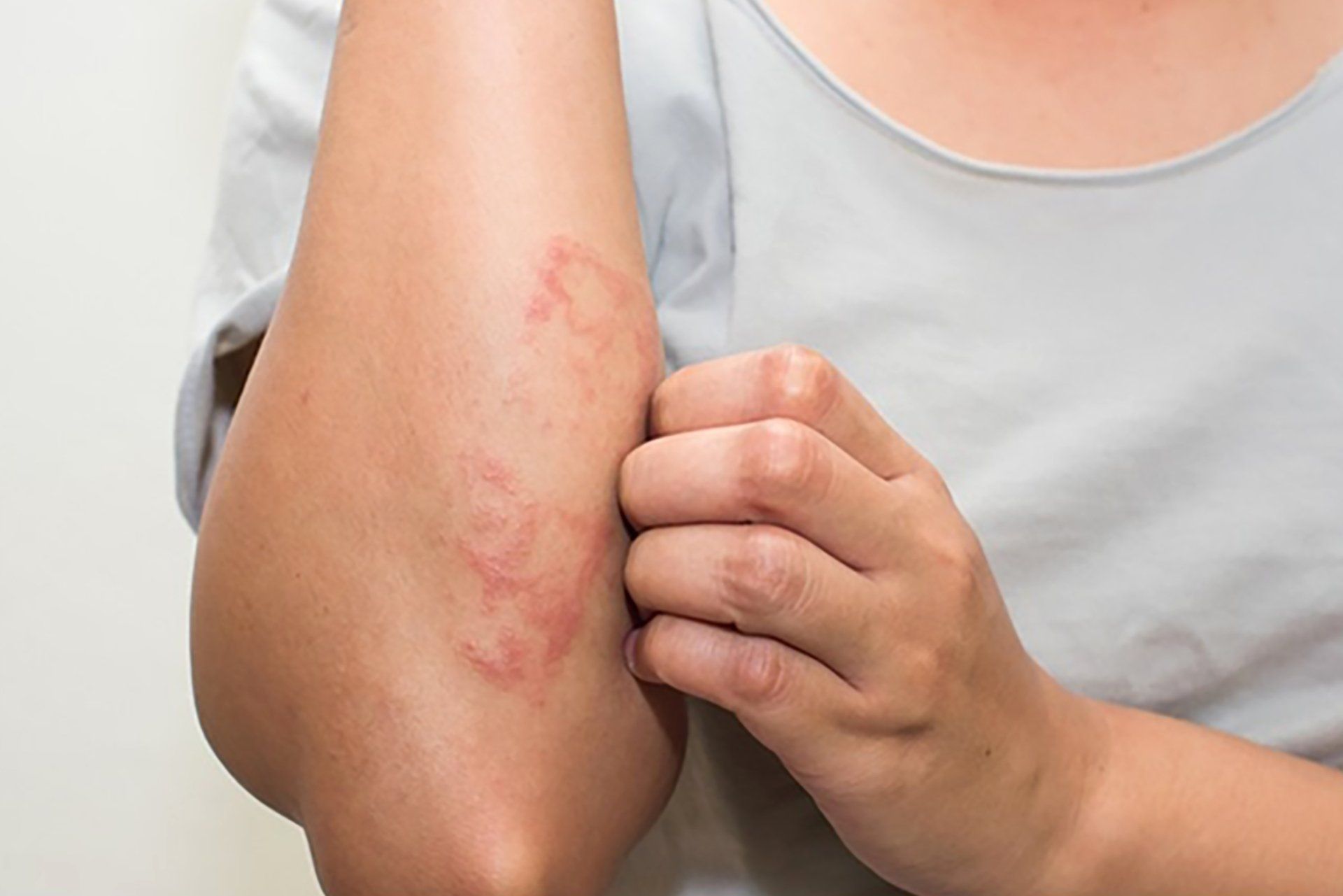 Person scratching an arm with a red, irritated rash on the elbow.