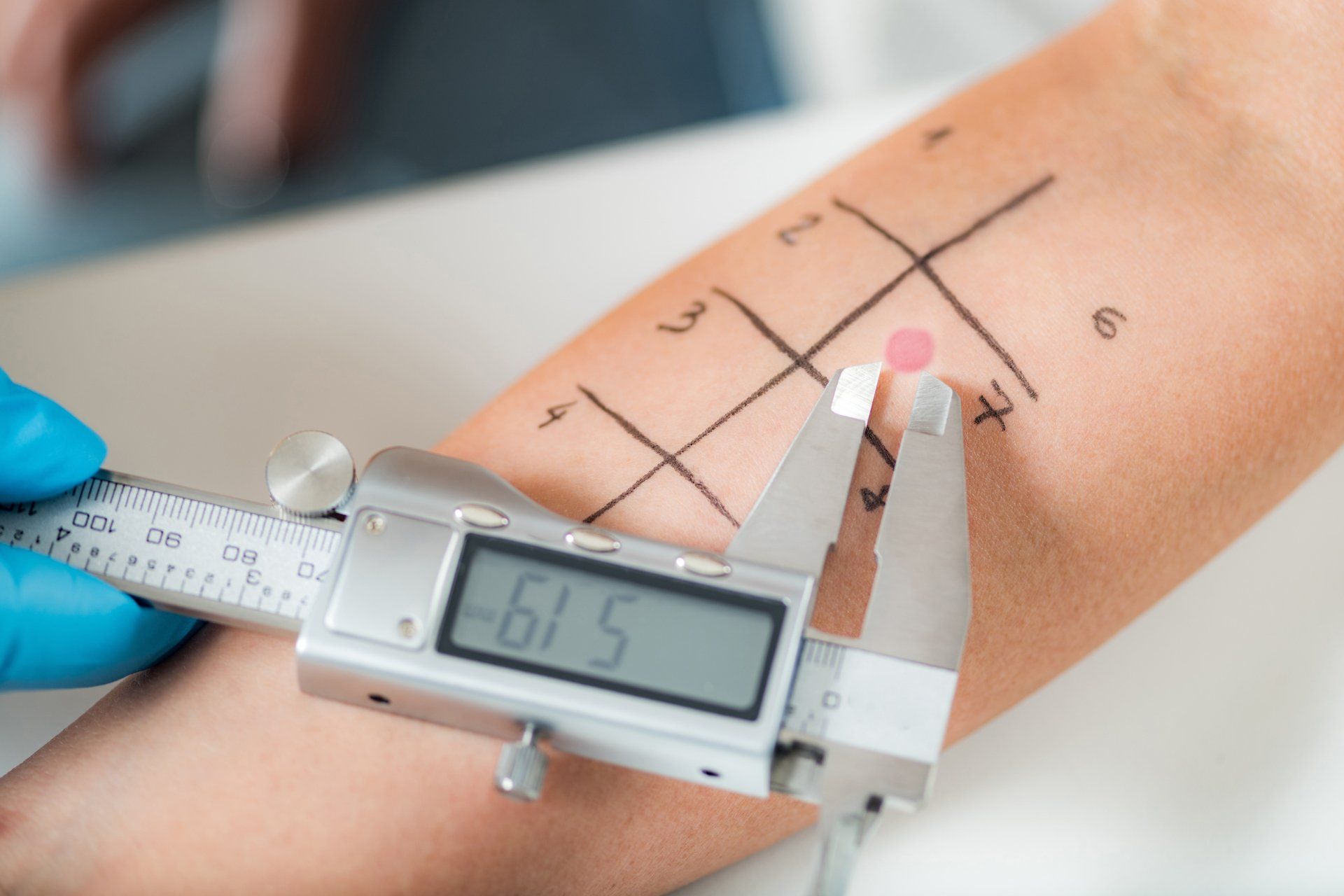 Arm with allergy test spots being measured with digital calipers.