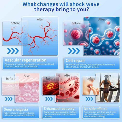 Shockwave Therapy Benefits: Cell Repair, Pain Relief & Recovery