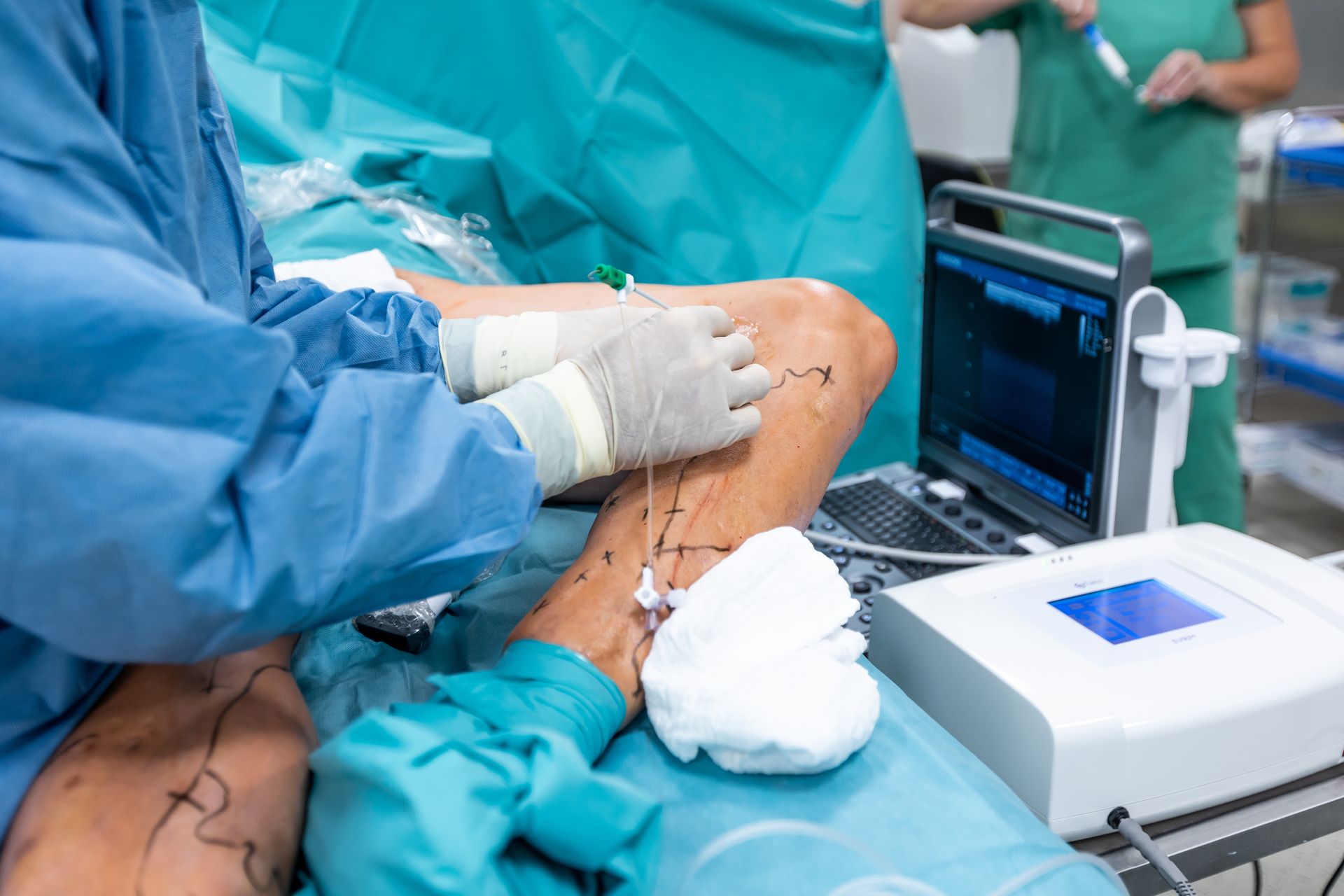 A professional vascular surgeon performs a specialized leg procedure using medical technology.