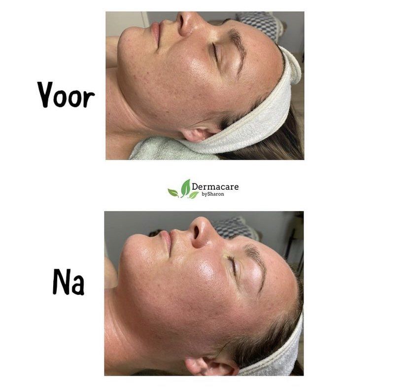 Een voor en na foto van het gezicht van een vrouw.