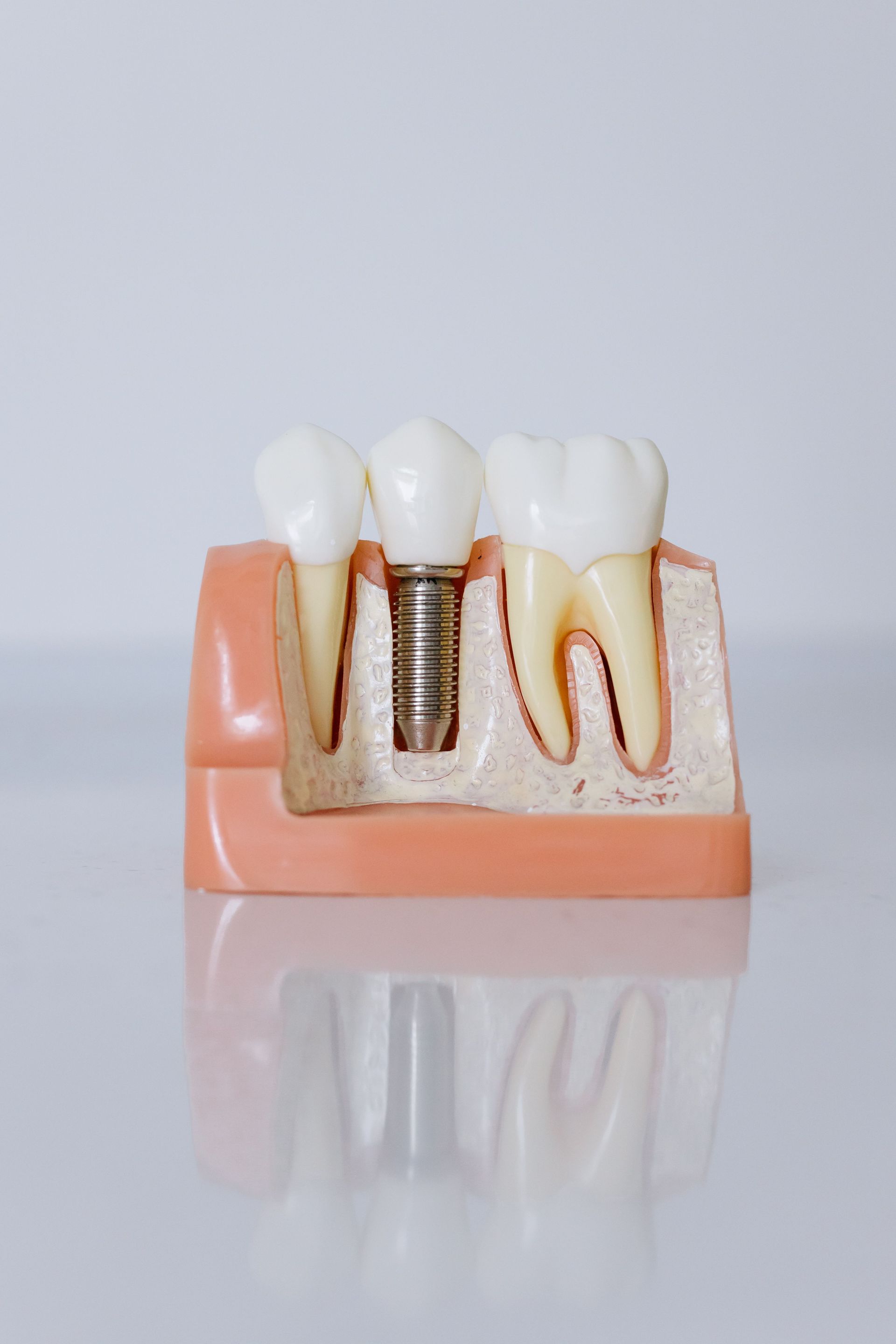 Snap-in dentures secured on dental implants at Encino Dental Group