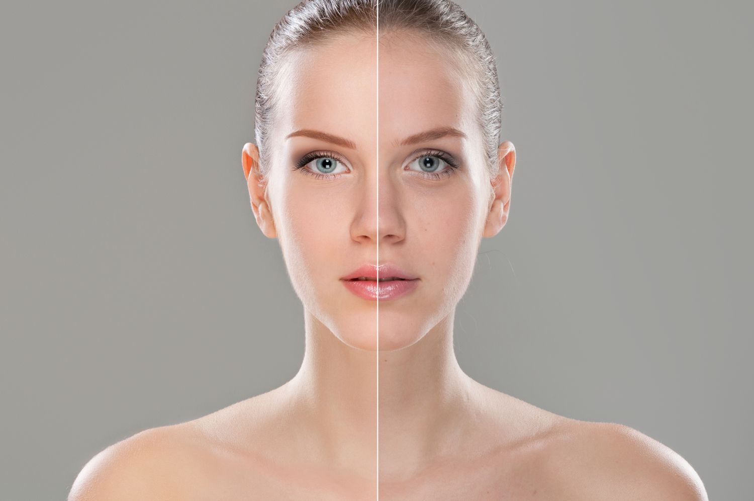 Acne — Pittsburgh, PA — South Hills Dermatology, PC
