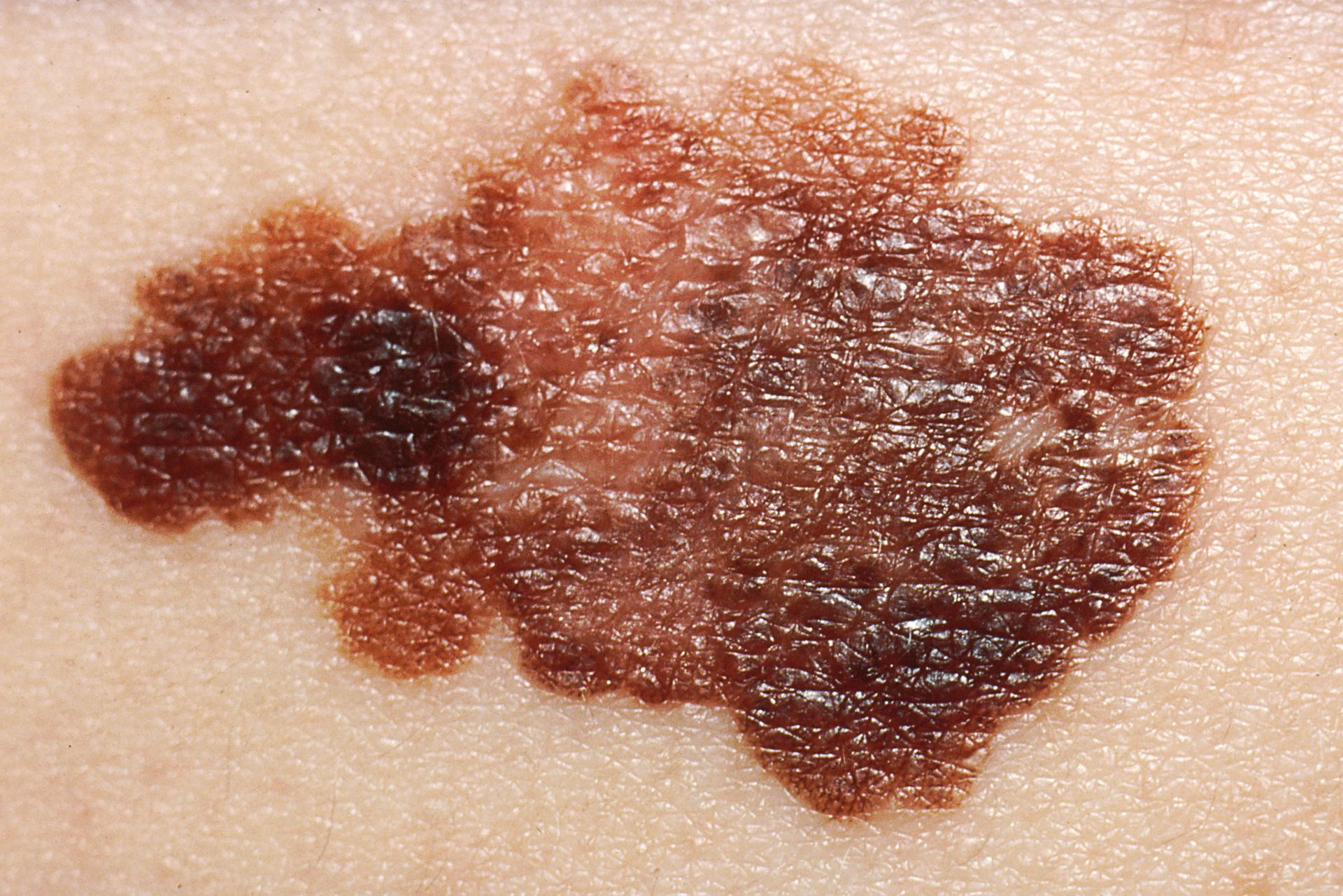 Melanoma — Pittsburgh, PA — South Hills Dermatology, PC