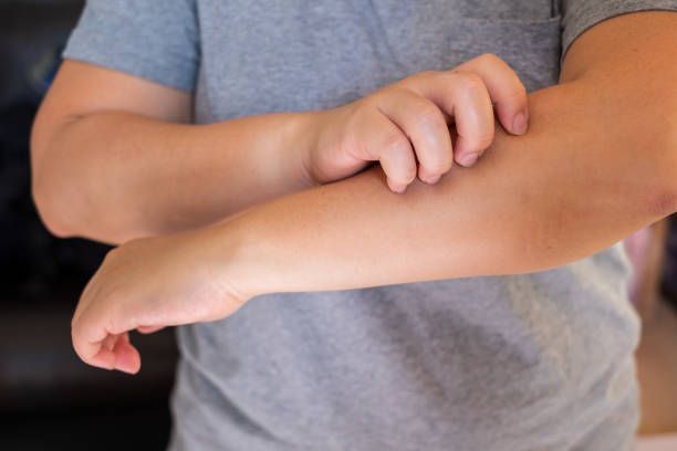 Dermatomyositis — Pittsburgh, PA — South Hills Dermatology, PC