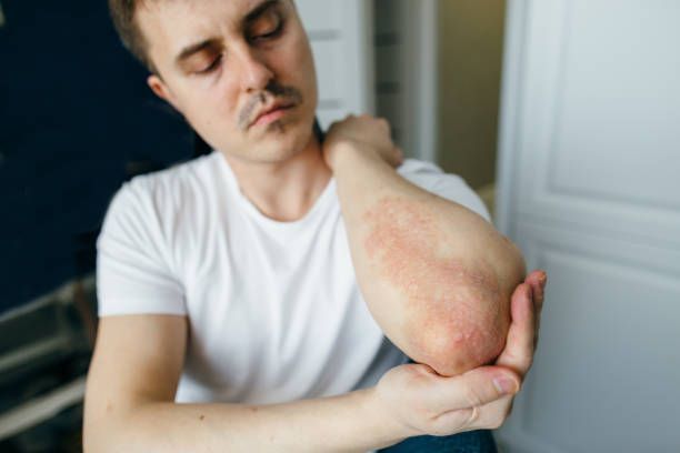Psoriasis — Pittsburgh, PA — South Hills Dermatology, PC