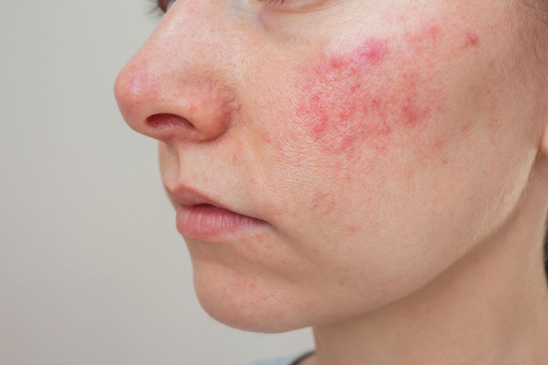 Rosacea — Pittsburgh, PA — South Hills Dermatology, PC