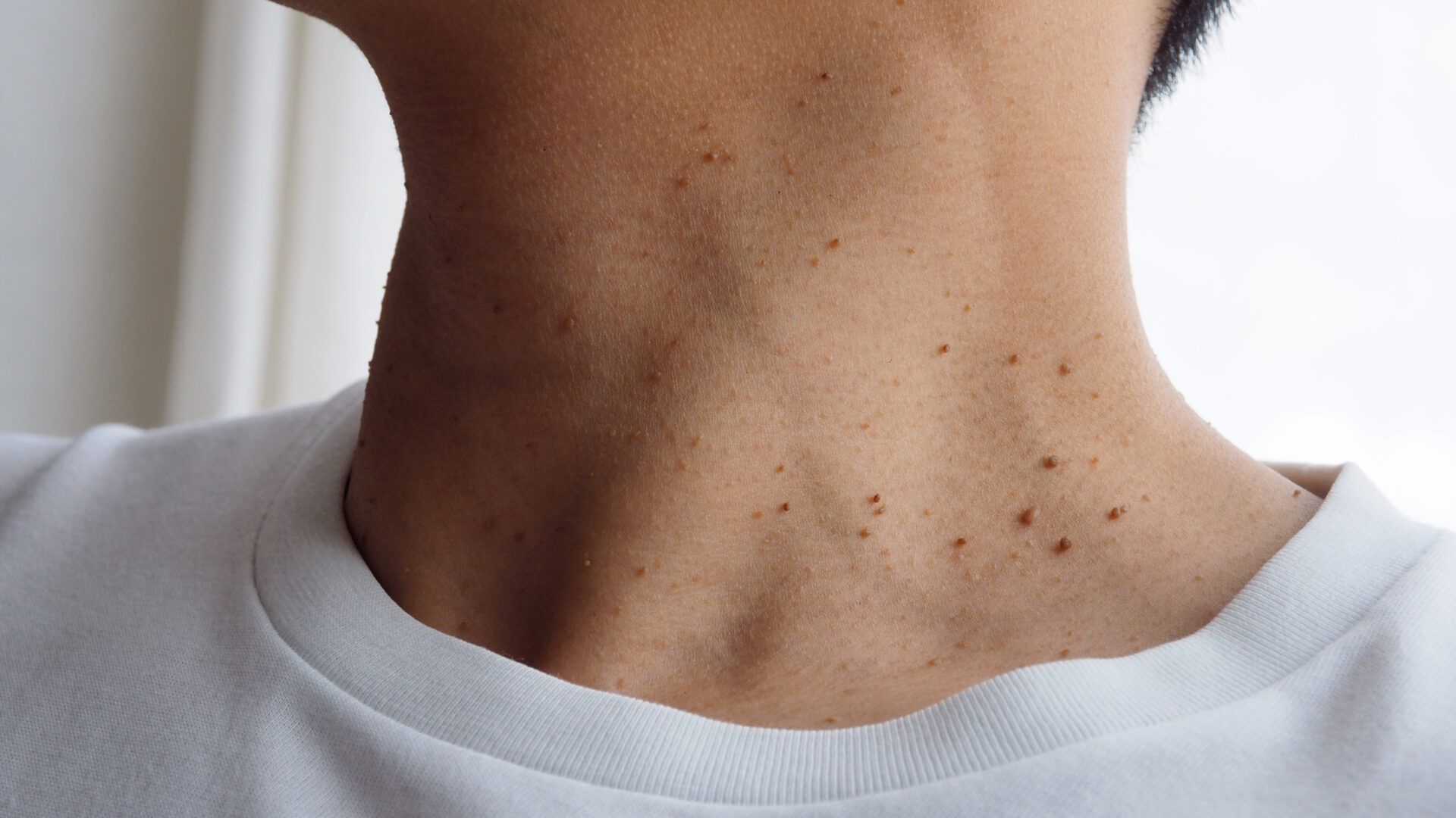 Neck with scattered brown spots, wearing a white shirt.