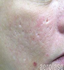 Acne scars treatment results