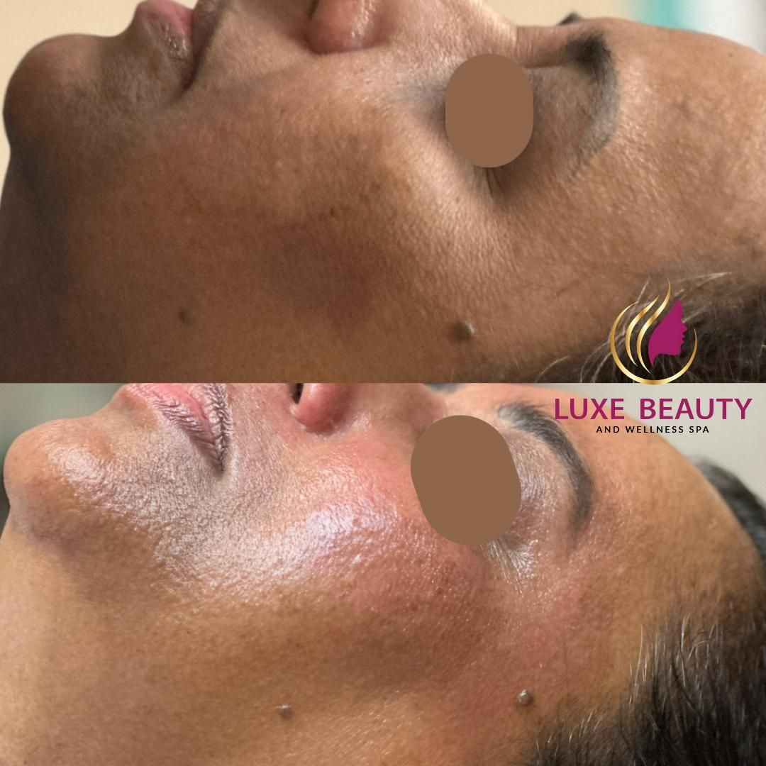Before and after facial hyperpigmentation showing improved skin tone after treatment