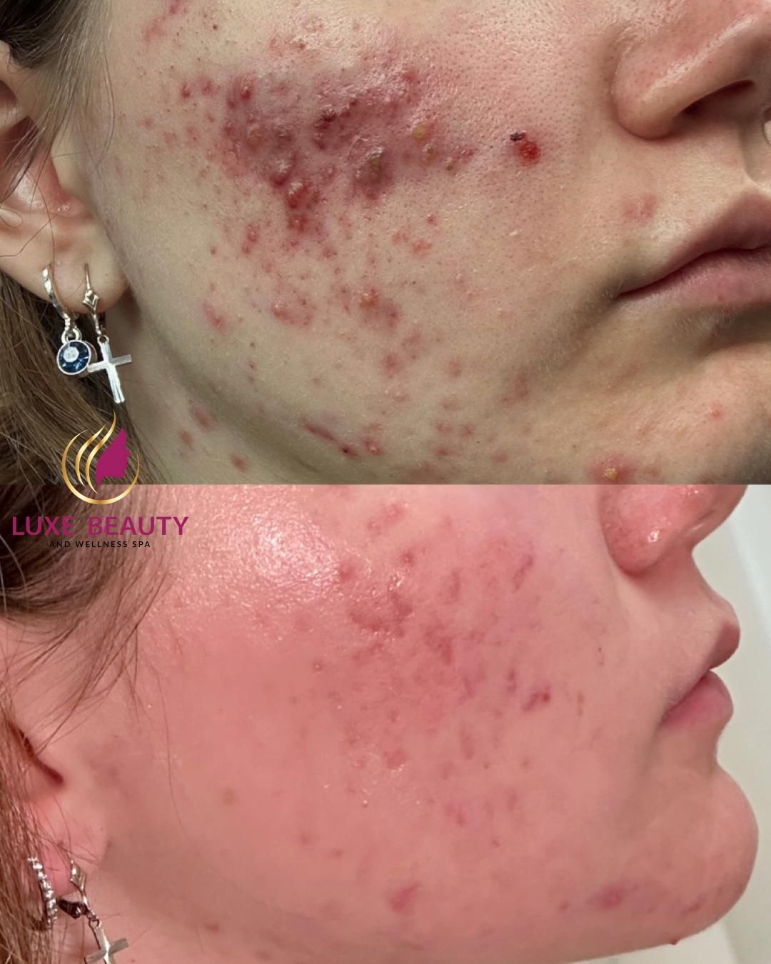 Cheek acne with inflamed breakouts and redness