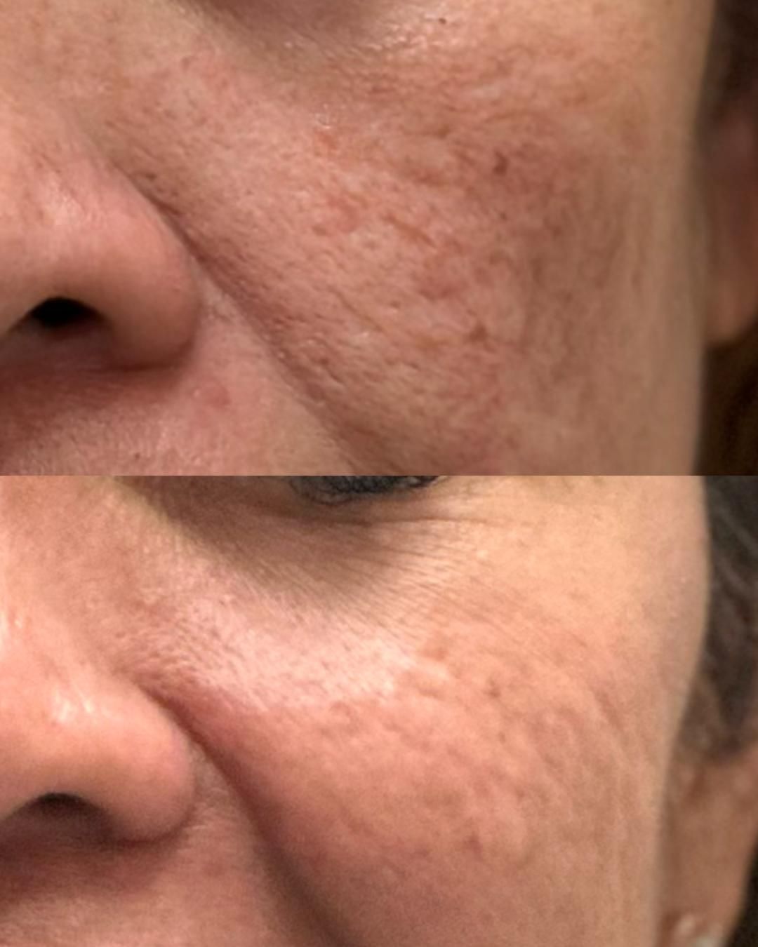 Cheek skin showing enlarged pores and uneven texture