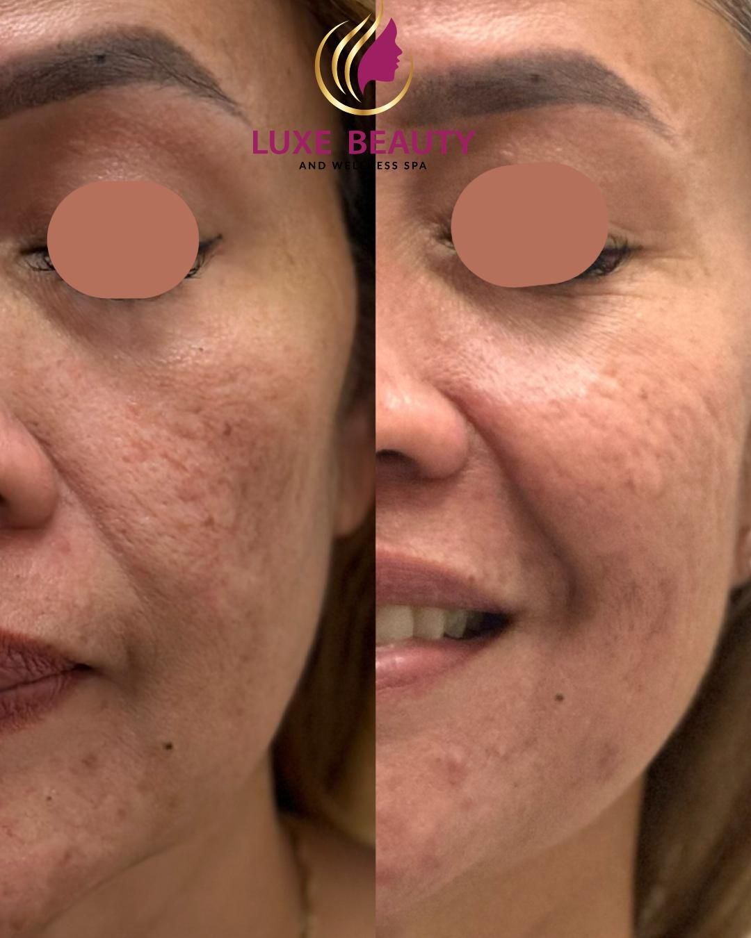 Under eye area before and after showing improved skin tone and reduced fine lines