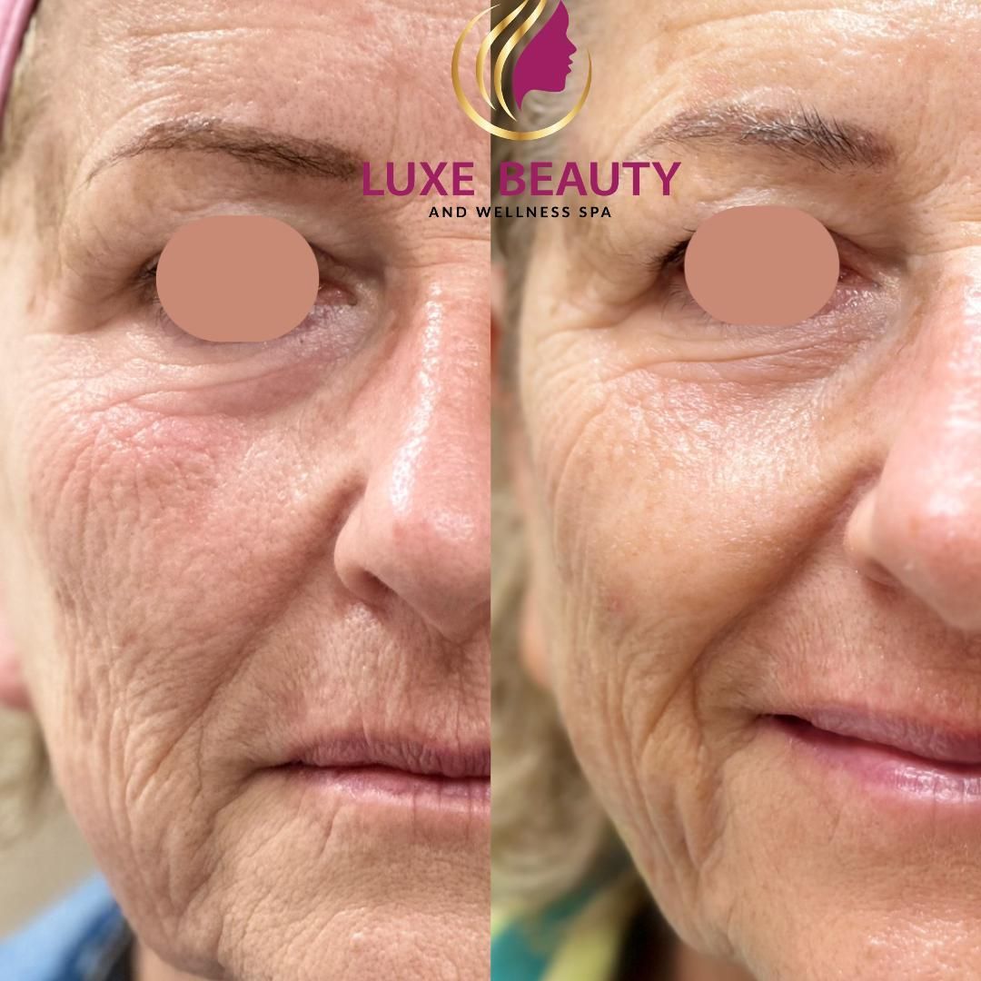 Under eye before and after showing reduced wrinkles and improved skin texture
