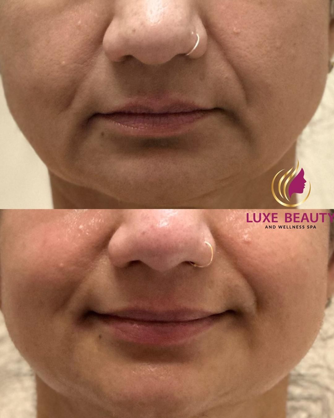 Lower face skin showing fine lines and uneven texture around mouth area