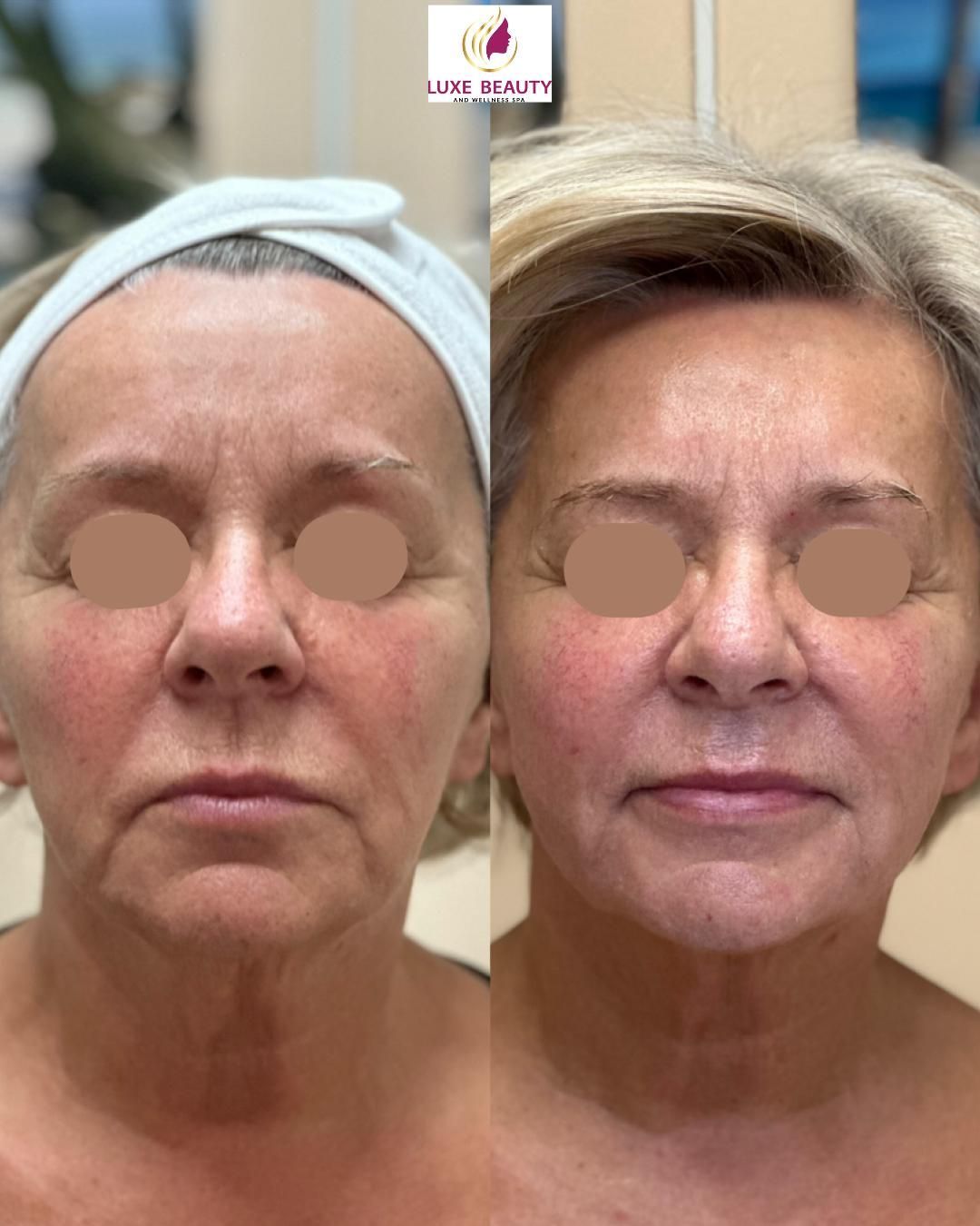 Full face before and after showing improved skin tone and overall appearance