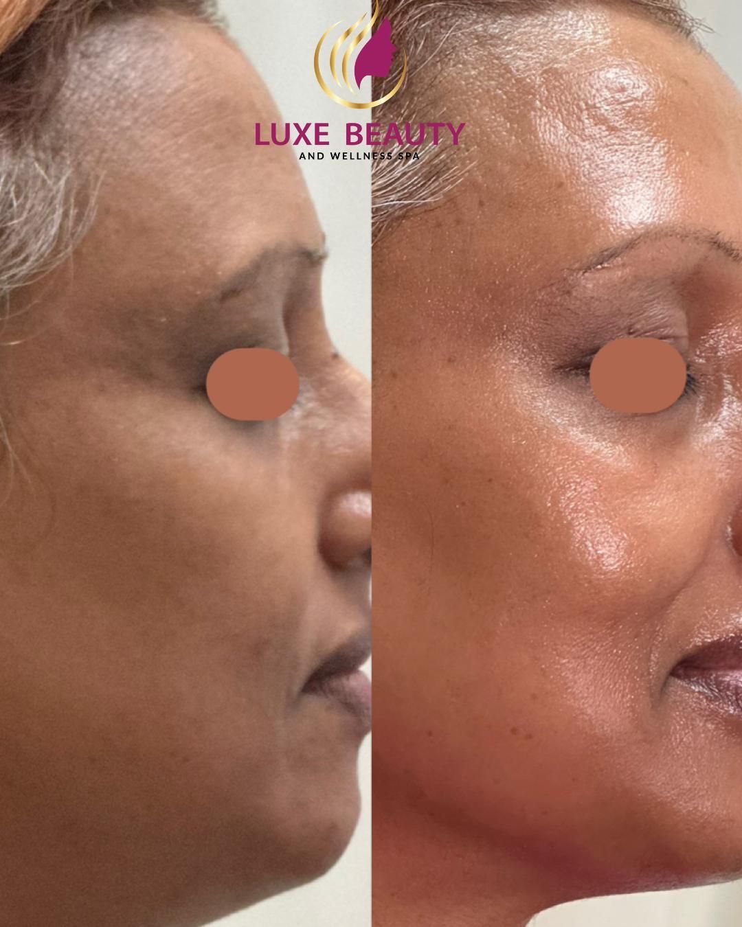 Forehead before and after showing reduced wrinkles and smoother skin texture
