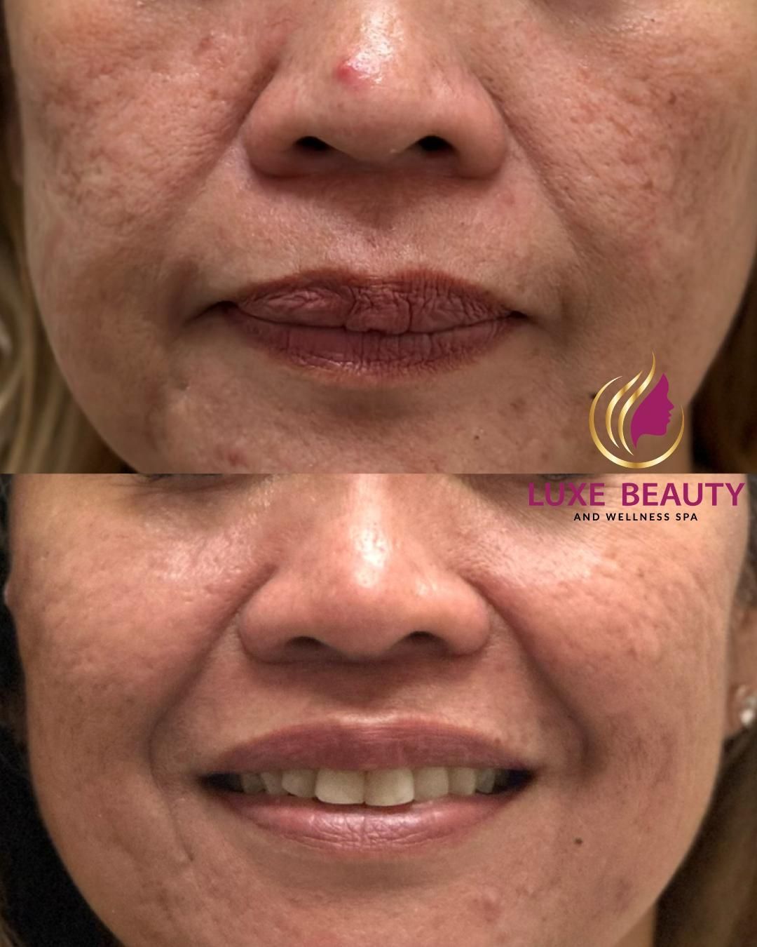 Lower face wrinkles around mouth showing fine lines and skin aging