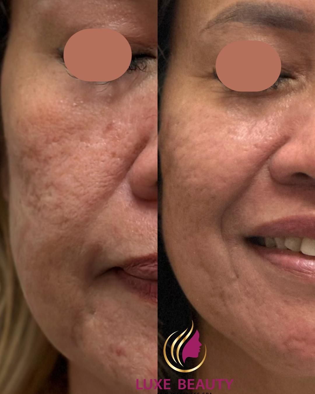 Under eye area before and after showing reduced dark circles and improved skin tone