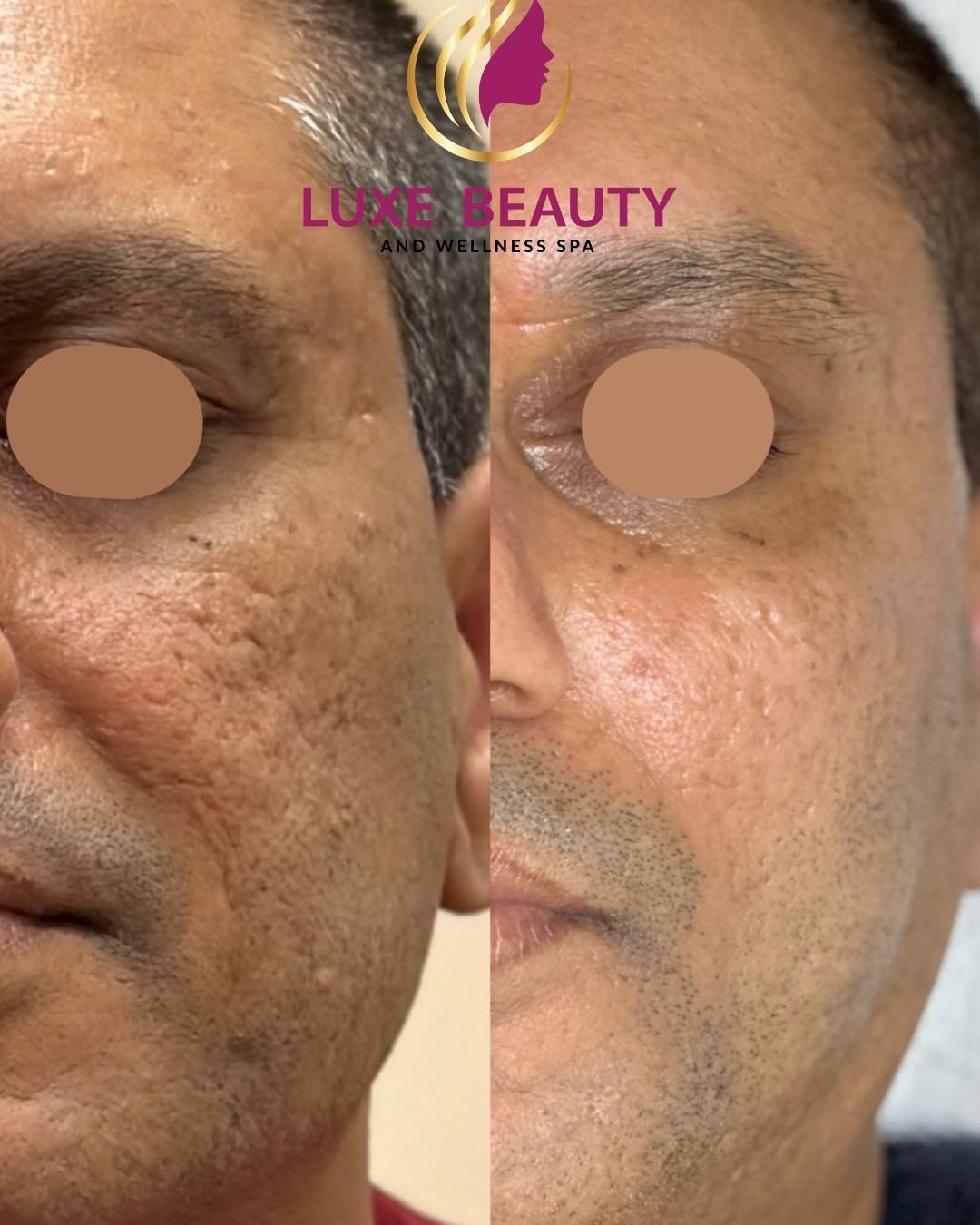 Under eye area before and after showing reduced dark circles and improved skin tone