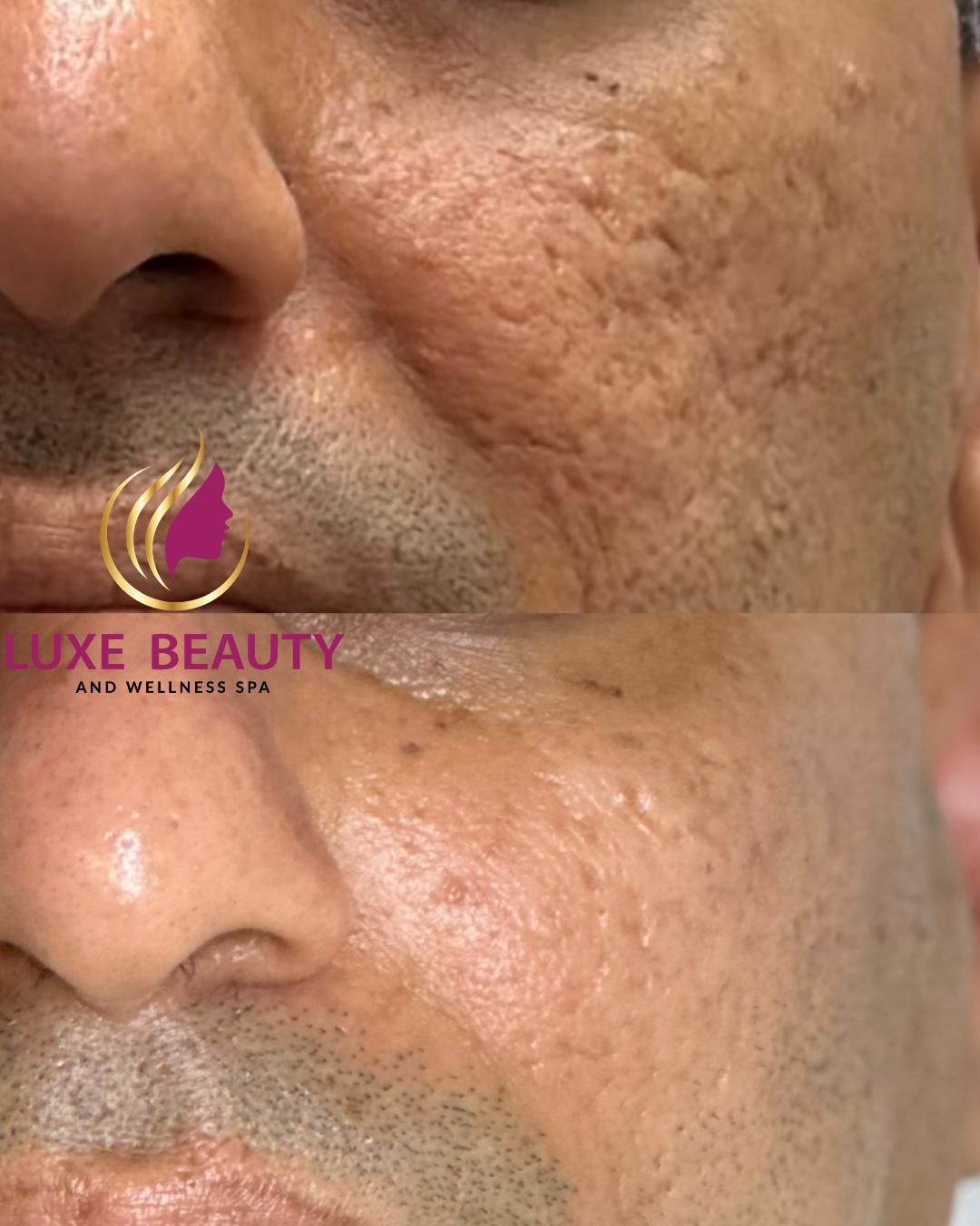 Cheek skin showing fine lines and uneven texture