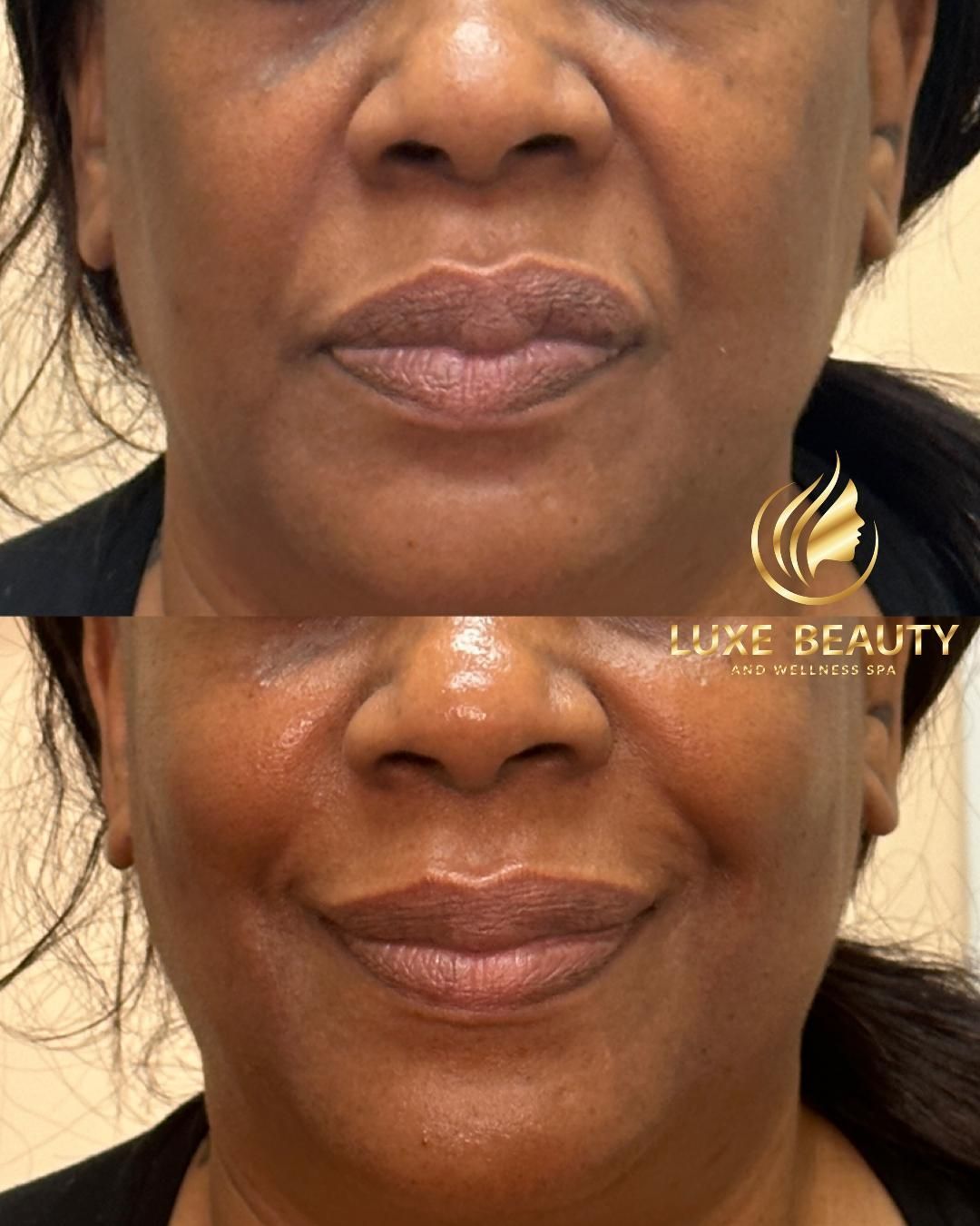 Lower face wrinkles around mouth showing skin aging and fine lines