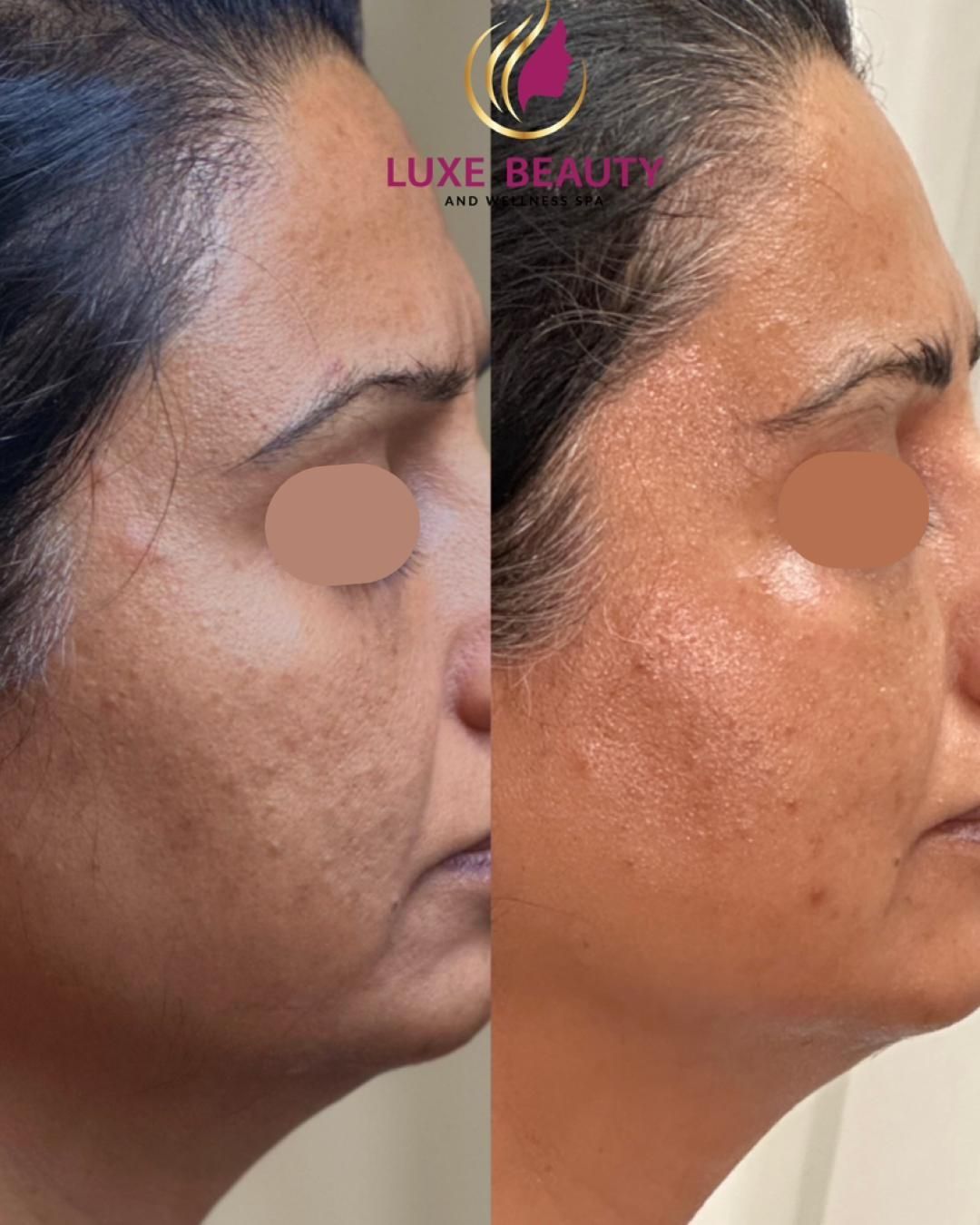 Forehead before and after showing reduced fine lines and improved skin texture