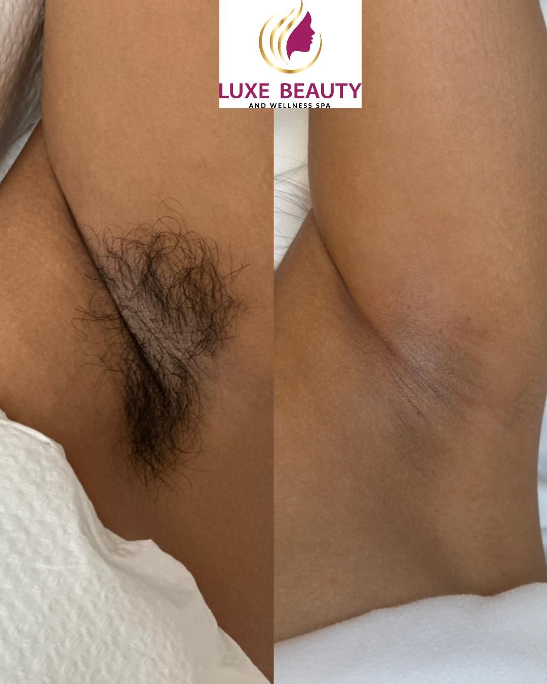 Underarm hyperpigmentation showing darkened skin and uneven tone