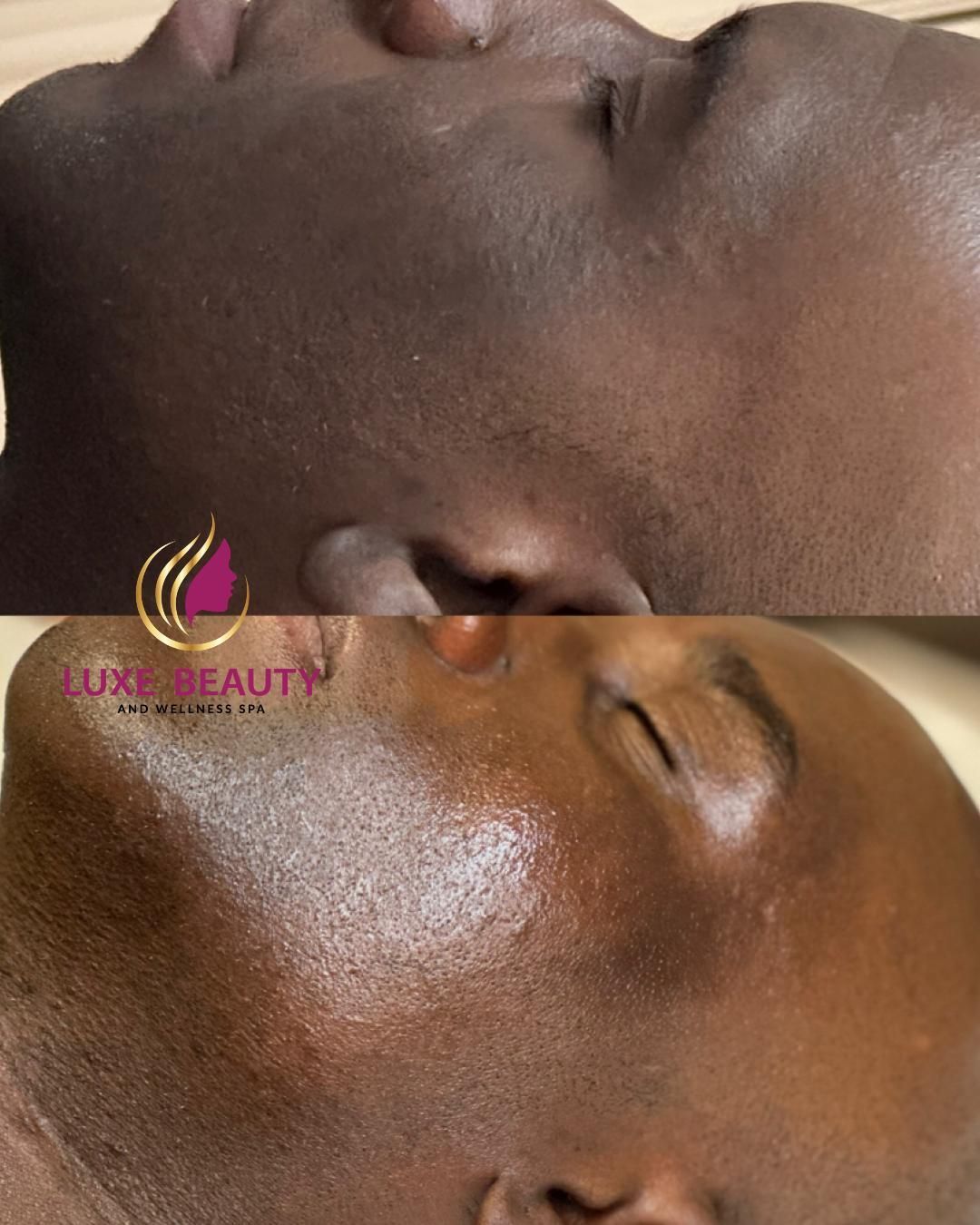 Side face hyperpigmentation showing uneven skin tone and dark patches