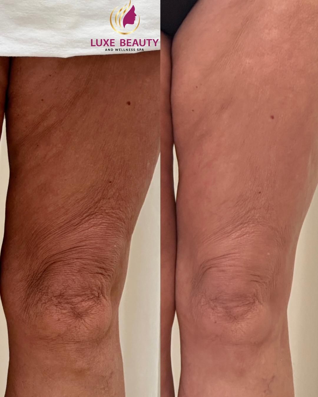Thigh skin showing uneven tone and texture before and after improvement