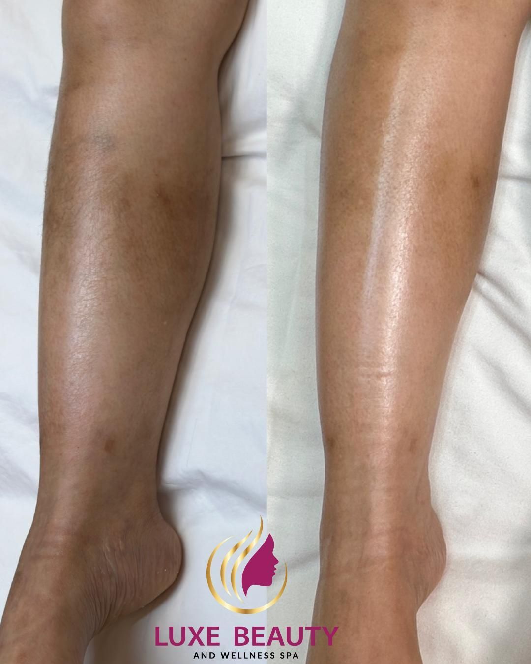 Legs showing before and after improvement in skin tone and texture