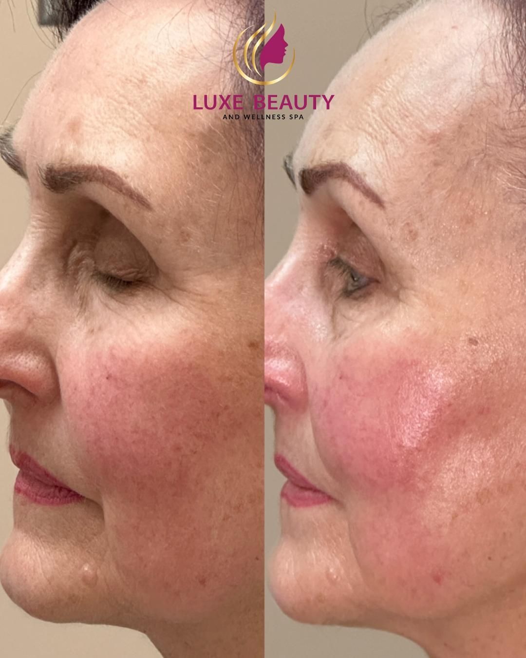 Under eye area before and after showing improved skin tone and reduced discoloration