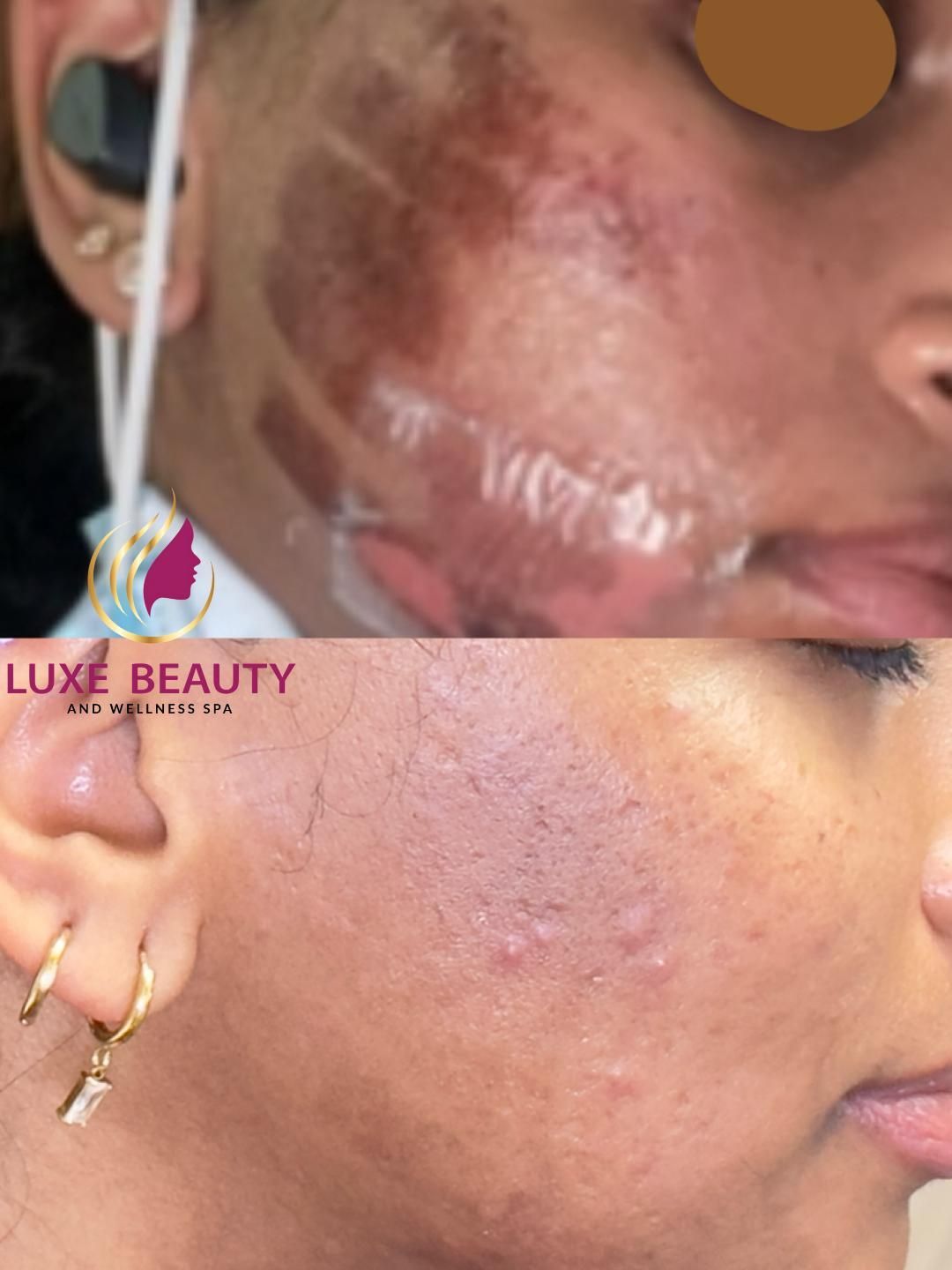 Cheek hyperpigmentation with dark patches and uneven skin tone