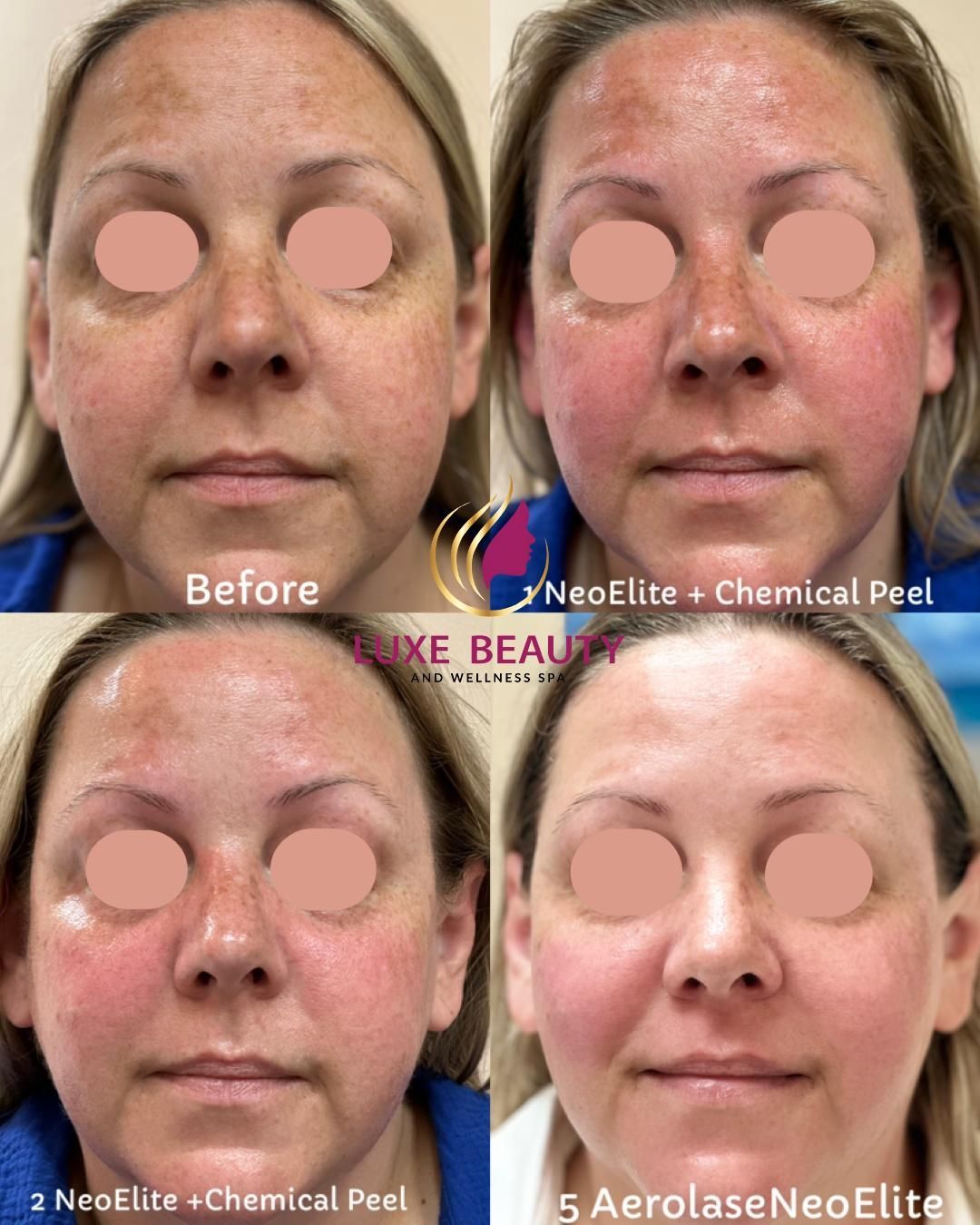 Full face before and after showing improved skin tone and overall appearance