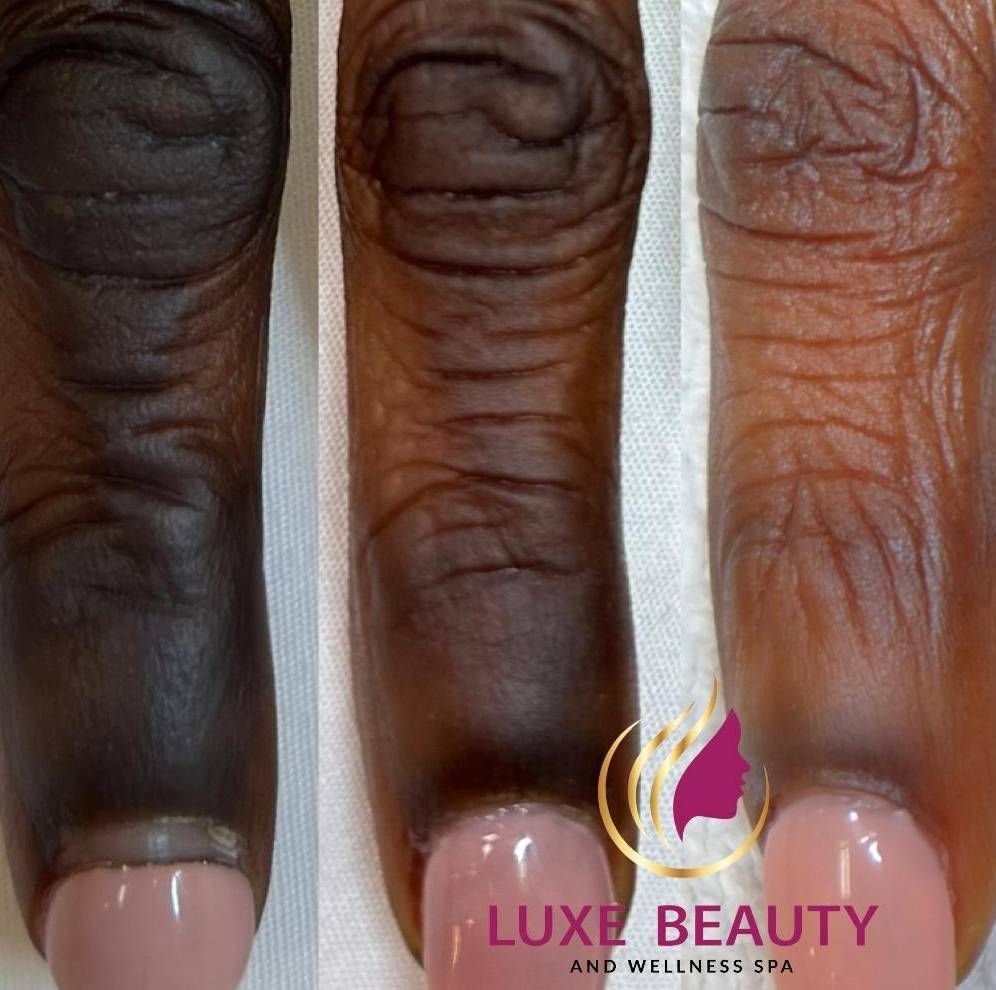 Melasma and hyperpigmentation on different skin tones treated safely in Mississauga clinic