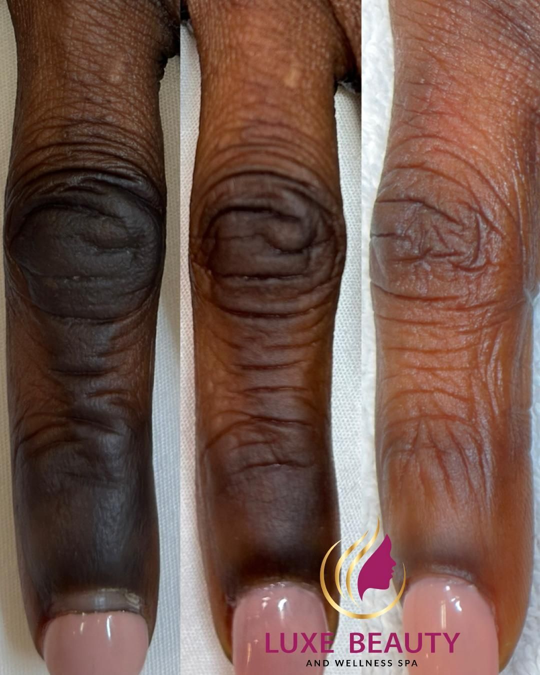 Dark pigmentation on fingers showing uneven skin tone and discoloration