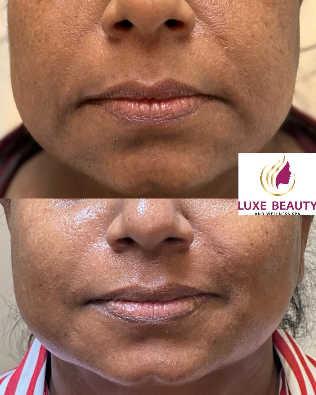 Lower face wrinkles and skin laxity around mouth area