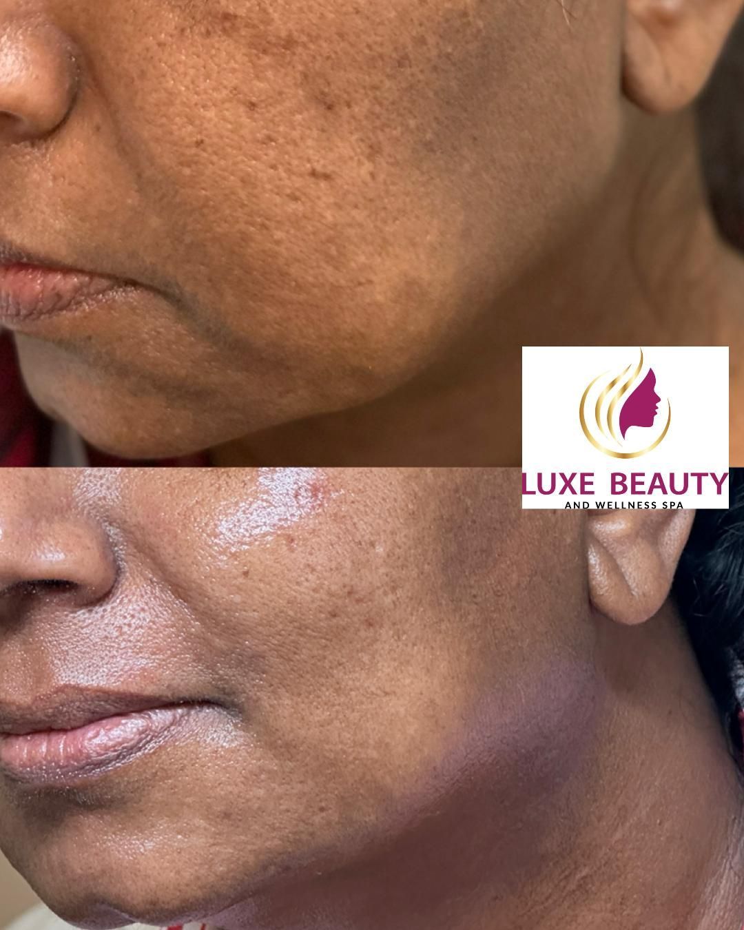 Cheek skin texture with mild pigmentation and uneven tone