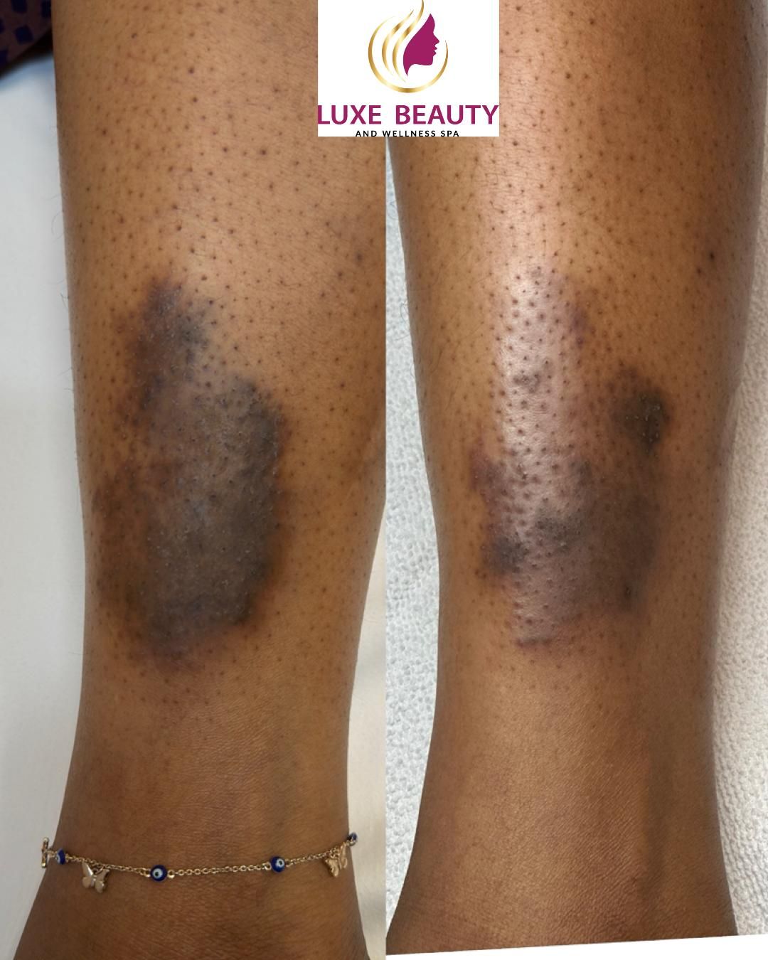 Dark spots on legs showing hyperpigmentation and uneven skin tone