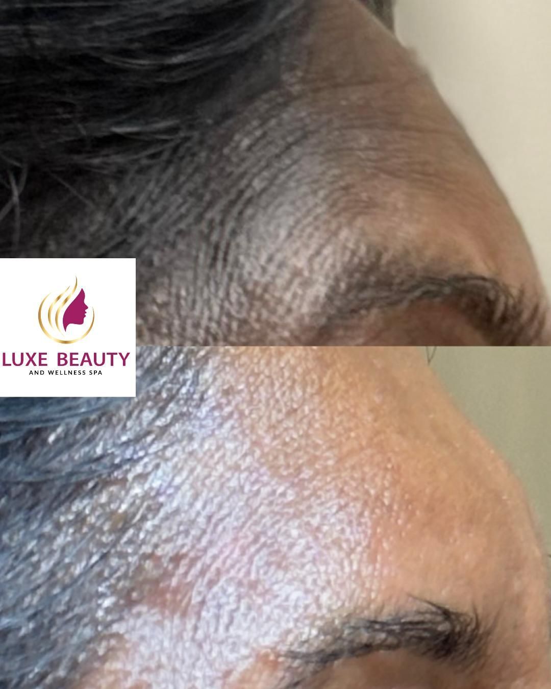 Forehead wrinkles and fine lines showing skin aging and texture