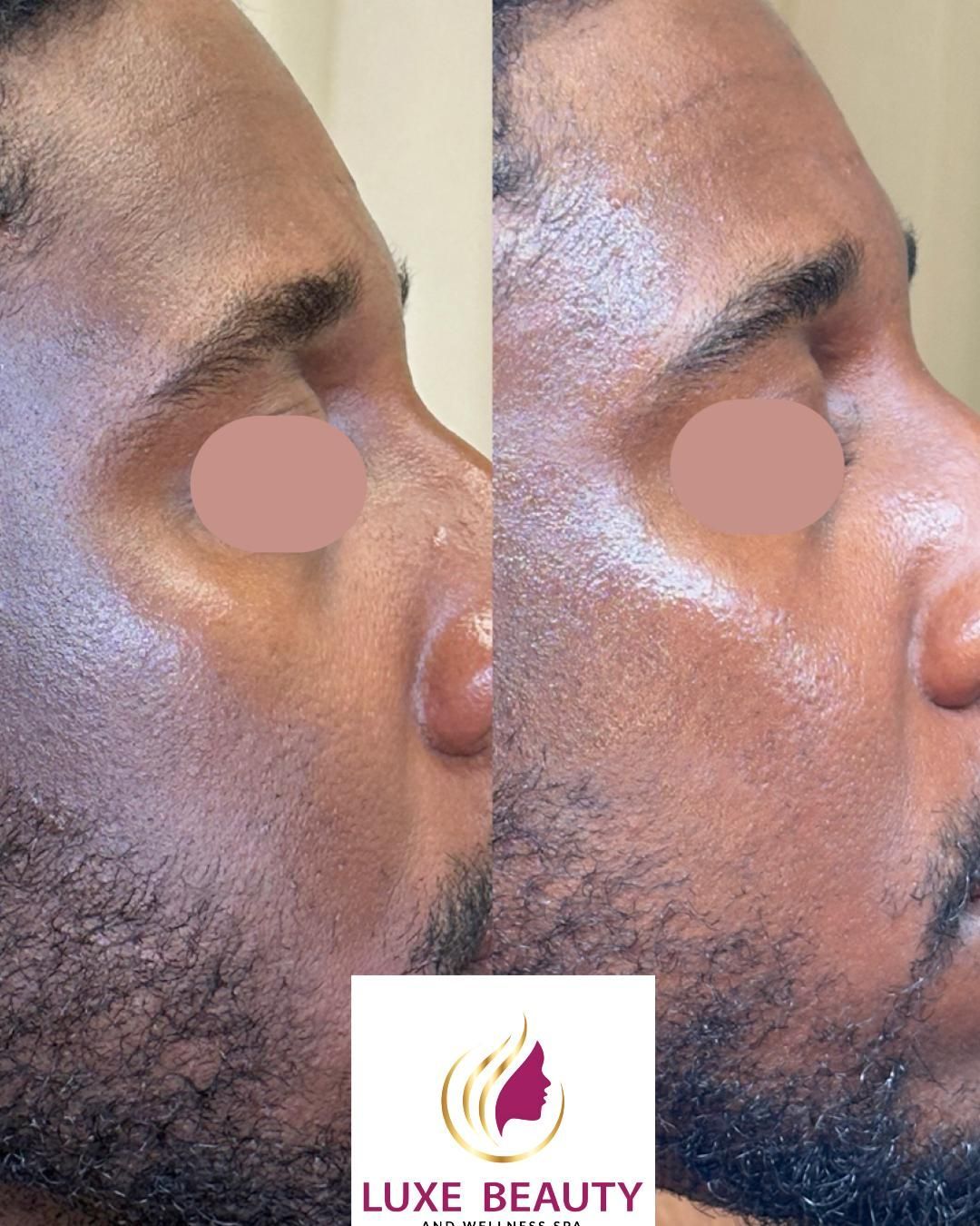 Under eye and cheek area before and after showing improved skin tone and reduced discoloration