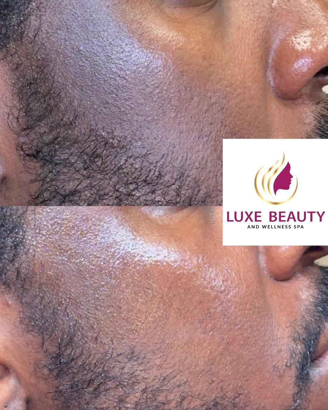 Jawline hyperpigmentation with dark patches and uneven skin tone