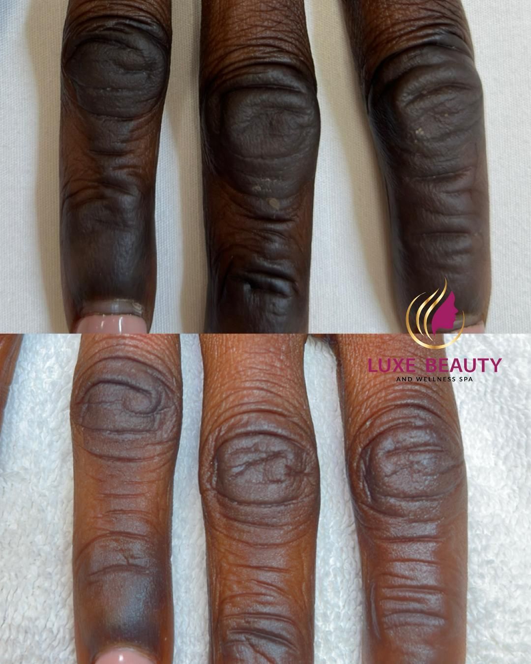 Dark pigmentation on fingers showing uneven skin tone and discoloration