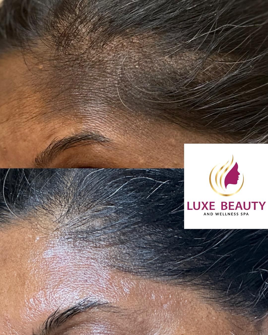 Forehead skin texture near hairline showing fine lines and uneven tone